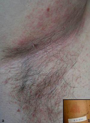 Contact dermatitis due to fragrances manifesting as axillary eczema associated with the use of a deodorant containing lyral. A, Erythematous lesions with an eczematous appearance that had appeared on the right axilla several weeks previously. B, Patch test with lyral showing a positive reading at 72hours.