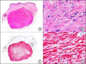 Cutaneous angioleiomyoma. A, Low-power magnification (×10). B, High-power magnification of neoplastic cells showing elongated nuclei with blunt ends and eosinophilic cytoplasm (×400). C, The same sample studied immunohistochemically with desmin (×10). D, Detail of desmin-positive neoplastic cells (×400).