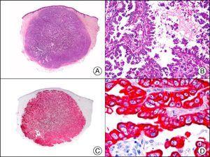 Cutaneous metastasis of papillary carcinoma of the endometrium. A, Low-power magnification (×10). B, Detail showing papillae lined with atypical epithelial cells (×200). C, The same sample studied immunohistochemically with cytokeratin (CK) 8/18 (×10). D, Detail of CK8/18-positive neoplastic cells (×400).