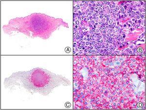 Specific cutaneous infiltration in multiple myeloma. A, Low-power magnification. B, Detail of neoplastic plasma cells. C, The same specimen studied immunohistochemically with MUM-1. D, Detail of MUM-1-positive neoplastic cells.