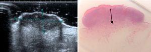 Ultrasound and histologic assessment of tumor thickness.