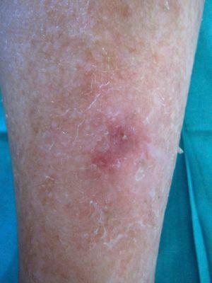 Mild erythema and desquamation 3 months after the photodynamic therapy session.