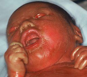 Collodion baby, der efterfølgende udviklede sig til en lamellær ichthyosis fænotype.