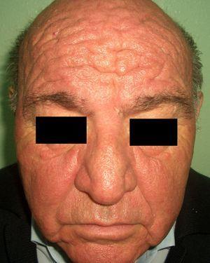 Carcinoid syndrome (facies leonine).