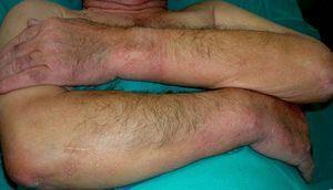 Scleromyxedema (waxy papules on the upper extremities).