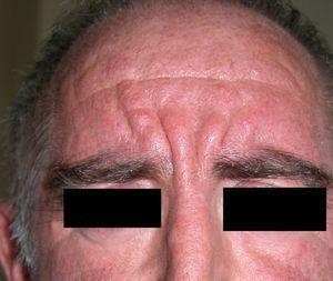 Pachydermoperiostosis (facial thickening).