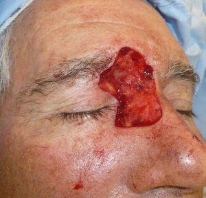 Wound at the medial canthus of the right eye after the third stage of Mohs surgery.