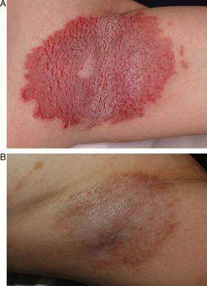 A, 47-year-old patient with axillary Hailey-Hailey disease. B, Outcome 1 year after treatment with carbon dioxide laser skin resurfacing. Note the postinflammatory hyperpigmentation with no evidence of recurrence.