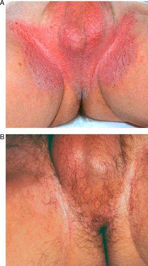 A, 63-year-old patient with inguinal Hailey-Hailey disease. B, Photo taken 1 month after treatment with carbon dioxide laser skin resurfacing. Note the postoperative erythema.
