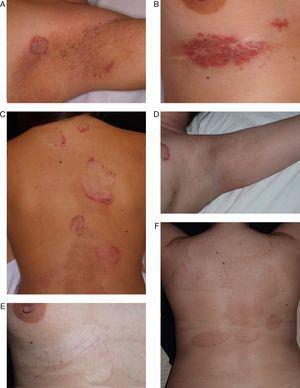 A 29-year-old patient with Hailey-Hailey disease. A, Lesions in the axillary area. B, Lesions in the submammary region. C, Lesions on the posterior aspect of the trunk. D, E, F. Appearance of lesions 9 months after treatment with carbon dioxide laser skin resurfacing. Note the considerable improvement in the lesions and the areas of residual hypopigmentation and hyperpigmentation. Despite these skin changes, the patient decided to undergo further treatment of lesions in other areas.