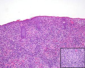 Skin biopsy specimen showing diffuse lymphohistiocytic dermal infiltrate with numerous poorly formed granulomas (hematoxylin-eosin, original magnification×100). Inset, nonnecrotizing epithelioid granuloma (hematoxylin-eosin, original magnification×400).
