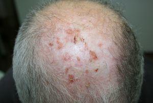 Response to Photodynamic Therapy for Pustular Dermatosis of the Scalp ...