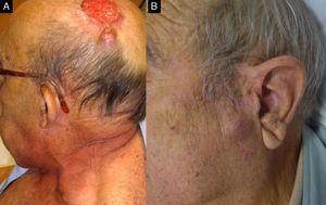 A and B, Two patients, aged 67 and 69 years, respectively, treated for high-risk squamous cell carcinoma on the scalp (A) and the temple (B). The 2 patients developed invasion of the upper cervical lymph nodes in the second year of follow-up.