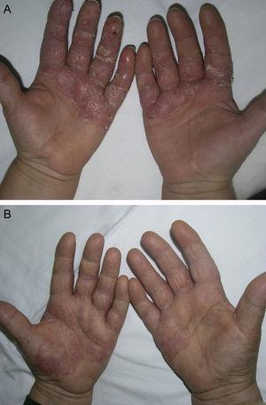Example of a patient with palmar psoriasis. A, Prior to treatment. B, After treatment.
