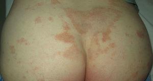 Purpuric lesions on both buttocks in a patient with pigmented purpuric lichenoid dermatosis.