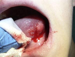Whitish sessile lesion with a verrucous surface on the left lateral border of the tongue.