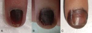 A, Initial clinical photograph showing homogeneous brown melanonychia. B, Two months later the periungual alterations were clearly visible. C, After 6 months of follow-up, the periungual component had become more pronounced.