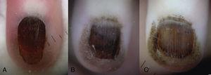 A, The initial dermoscopy revealed the presence of pigmented globules in the nail plate and in the proximal periungual skin. B, Two months later, pigmented globules were visible on a brown background, with narrow and regular longitudinal lines in the nail plate. C, At 6 months the dermoscopic pattern was unchanged.