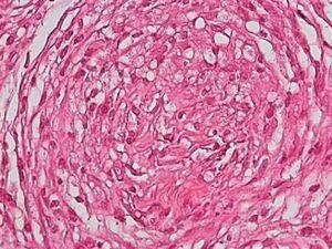 Granuloma in tuberculoid leprosy, showing foamy histiocytes arranged in a concentric pattern. Hematoxylin-eosin, original magnification ×400.