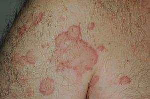Erythematous edematous lesions with purpuric borders at the top of the arm.