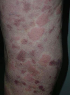 Residual purpuric plaques and erythematous, edematous lesions on the leg.