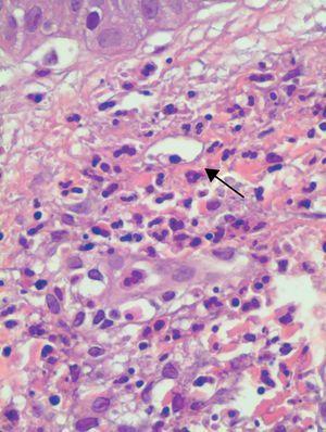Note the area of leukocytoclasia in the upper dermis, with blurring of the vascular wall (black arrow). (Hematoxylin-eosin, original magnification ×400).