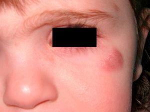 Asymptomatic red to violaceous nodule in the upper region of the left cheek.