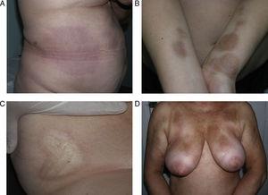 Different presentations of plaque morphea. A, A violaceous plaque characteristic of an early inflammatory lesion. B, Hyperpigmented plaques with minimal induration of the skin in the later phases. C, Indurated, ivory-colored plaque. D, Multiple, poorly defined, hyperpigmented plaques on the trunk.