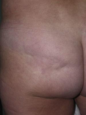 Single plaque of depressed skin with no other superficial changes. This is typical of circumscribed deep plaque morphea, subcutaneous morphea, or solitary deep morphea.