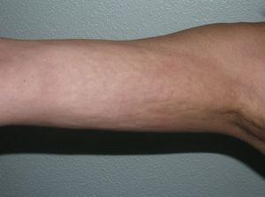 The skin of the medial aspect of the arms has an irregular, dimpled surface as a result of the deep sclerosis typical of eosinophilic fasciitis.
