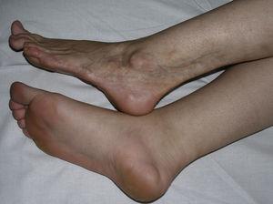 Band of depressed skin that extends from the inferior region of the calf to the tips of the lateral toes, associated with disappearance of the adipose tissue and atrophy of deeper structures caused by linear scleroderma during the patient's childhood.