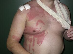 Disjointed areas of inflammation in a patient in whom the surgical field was covered with an occlusive plastic drape and who underwent the operation in a semirecumbent position.