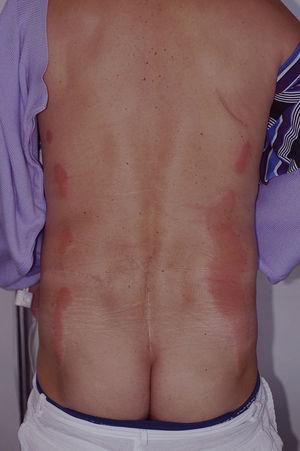 Parallel lesions in the lumbar region after the application of povidone iodine antiseptic prior to colectomy.
