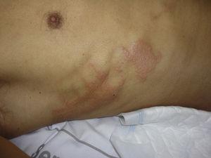 Irritant lesions caused by povidone iodine on the anterior chest wall in a patient operated in the prone position for lumbar arthrodesis.