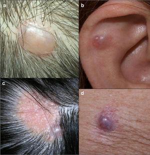 Clinical images. A, Nodule in the right parietal region. B, Cystic lesion on the helix. C, Nodule on sebaceous nevus on the scalp. D, Nodule on the right arm.