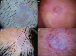 Dermatoscopic images. Homogeneous pattern of pale grey/bluish color, with whitish cotton -wool –-like structures and linear irregular vessels (A-D) and regions of brown-orange color (B and D).