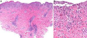 A, Deep perivascular lymphohistiocytic inflammatory infiltrate with involvement of the dermal-epidermal junction (hematoxylin-eosin, original magnification ×10). B, Detail showing interface alteration, fibrinoid necrosis in the vessel walls, and isolated necrotic keratinocytes (hematoxylin-eosin, original magnification ×40).