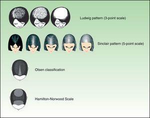 Female-pattern hair loss (progressive diffuse alopecia).