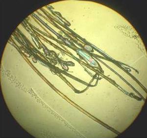 Telogen effluvium (>20% hairs in telogen phase). Polarized light microscope (original magnification ×10).