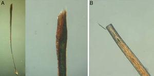 Examination of the distal end. A, Paintbrush tip (alopecia areata). B, Clean-cut tip (trichotillomania). Polarized light microscope (original magnification ×10 and ×40).