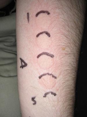 Minimal urticaria dose (MUD) in a patient with solar urticaria. Whealing response. MUD determined using a fluorescent lamp with 5 test fields and a filter to determine the exposure dose according to skin contact time (Gigatest UVB, Medisun). (Photograph courtesy of Dr Diego de Argila, Hospital La Princesa, Madrid, Spain).