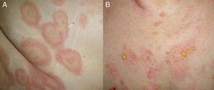 A, Urticaria-like lesions as the presenting form of bullous pemphigoid in a female patient. B, Tense blisters and erosions in the same patient some days later.