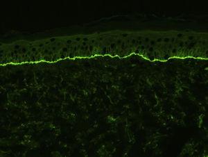 Linear deposits of C3 along the basement membrane observed by direct immunofluorescence study of the skin in a patient with bullous pemphigoid (original magnification ×200).