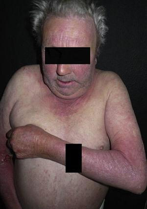 Scaly, erythematous lesions located predominantly in sun-exposed areas (face, upper chest, dorsal aspect of arms, and hands) in a patient with hydrochlorothiazide-induced photosensitivity.