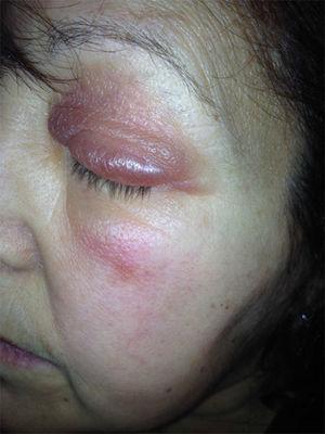 Eyelid swelling 24hours after onset. The lesion was neither warm to the touch nor painful and was more pronounced on the right.