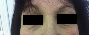 Swelling resolved after improvement of acute hypothyroidism.