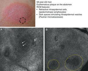 Confocal Microscopy Patterns in Nonmelanoma Skin Cancer and Clinical ...