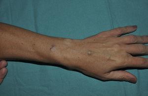 Bluish nodule on the mother's right forearm.