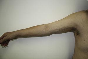 Edema of the right arm; note the dimpled appearance of the skin of the inner arm and the increased diameter of the forearm.