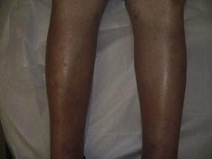 Bilateral edema and erythema of both legs.
